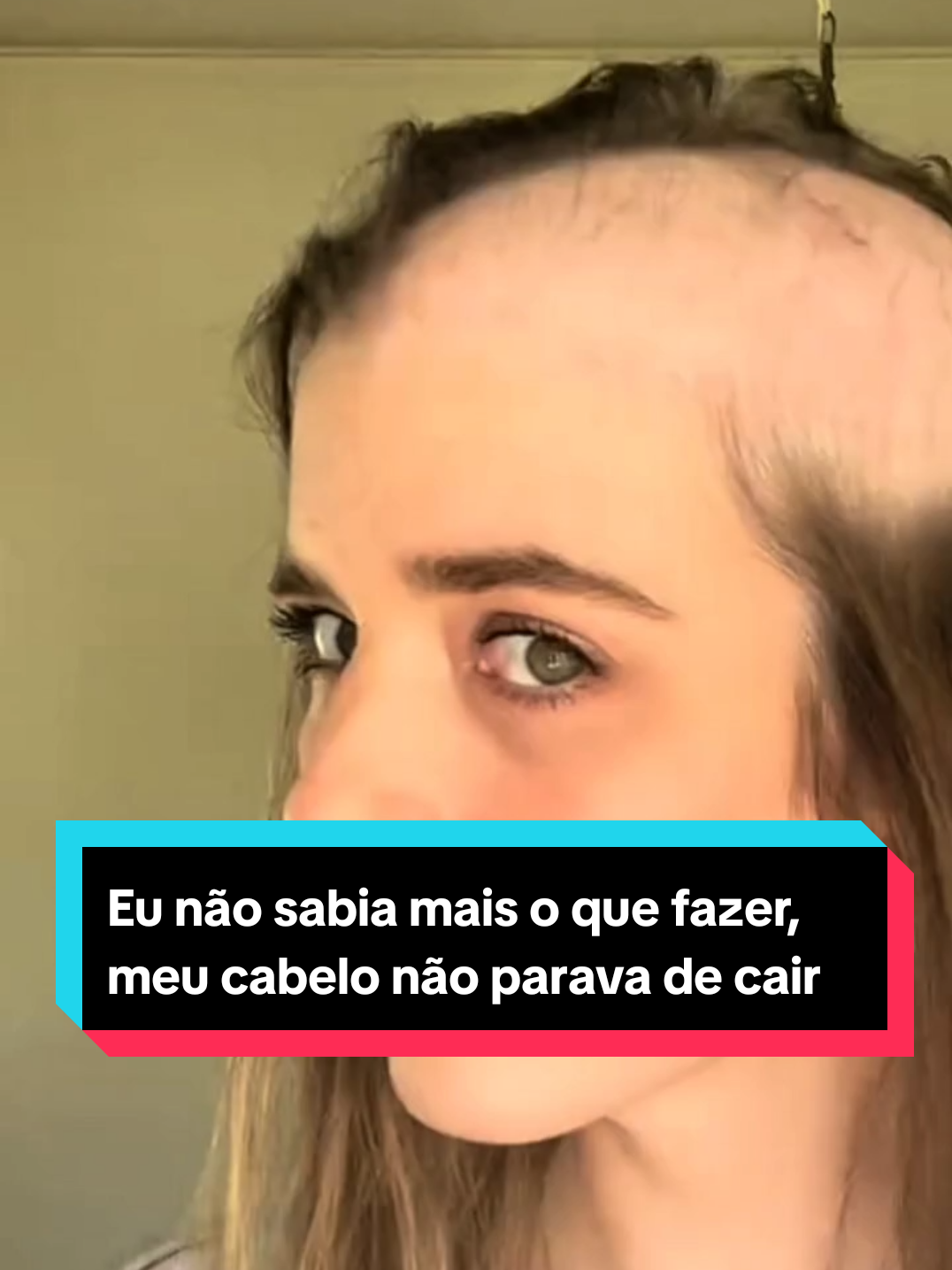 O meu cabelo começou a cair muito,  ao ponto deu ficar quase careca, e eu descobri a pior coisa da minha vida #cabelo #caindo #hospital #cancer 