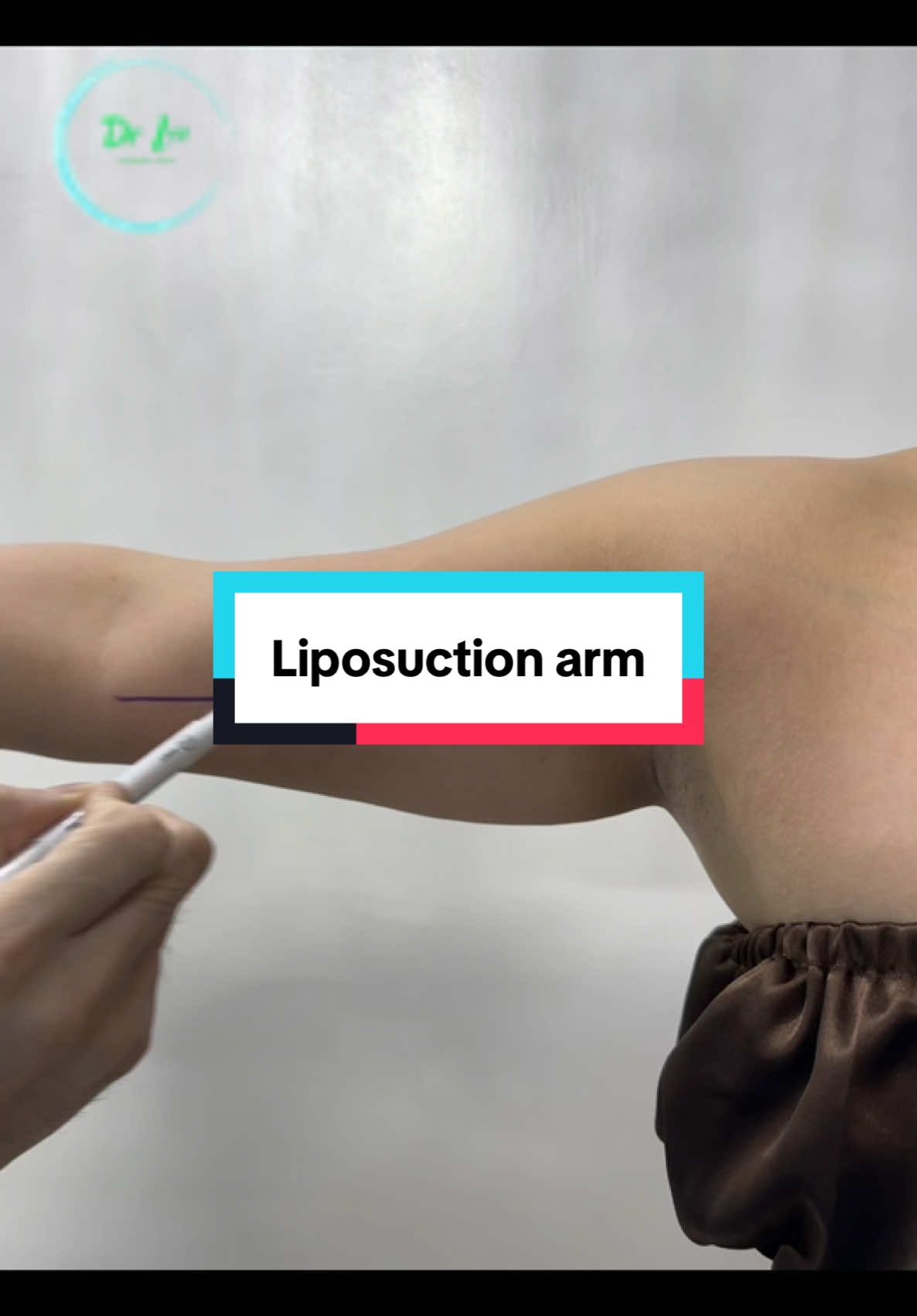 Big promotion sale 50% Liposuction#xuhuong #philippines #liposuction #clinic #surgery 