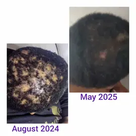 VOLUMICIOUS is Permanent Solution for your Hair Problems, a product suitable for All HAIR TYPES, made for Men, Women and Children.  The Volumicious Products are a Multi-function Solution to ALOPECIA (HAIRLOSS)  And other hair related problems.  Available in Sensitive and Non sensitive scalp Range  There are different types of HairLoss 💜Traction Alopecia (Receded Hairline) 💜Androgenic Alopecia (Bald Patches) 💜Telogen Alopecia (Induced by Pregnancy and Stress)  💜Anagen Alopecia(Induced by radiation from Chemotherapy)  💜Areata Alopecia (Induced by autoimmune disease)  They also help with 💜Dandruff 💜Serborric Dermatitis 💜Breakage 💜Thin Hair 💜Dry Scalp 💜Slow Growing Hair 💜Ring Worms These Results are not false claims but actual results from people who have used the Products. We Recommend to use the products in Combos for Faster and better Results Contact us today on 076 124 2375 to help you start your Hair journey You can also visit our Hair Clinics for Hair Treatments RIVERSANDS HAIR CLINIC 📱079 427 4485 ☎️010 006 7203 NORTHRIDING HAIR CLINIC 📱066 582 0601 #TRANSFORMWITHVOLUMICIOUS 