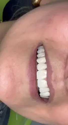🦷✨💎🧑🏻‍⚕️🪄 #rek#dentalschool#zirconium#естетика#the#best#smile#turkmenistan #ashgabat #dishdogtor #tiktok #рекомендации #emaxveneers #цирконий #туркменистан #зубы #keshfett #creatorsearchinsights 