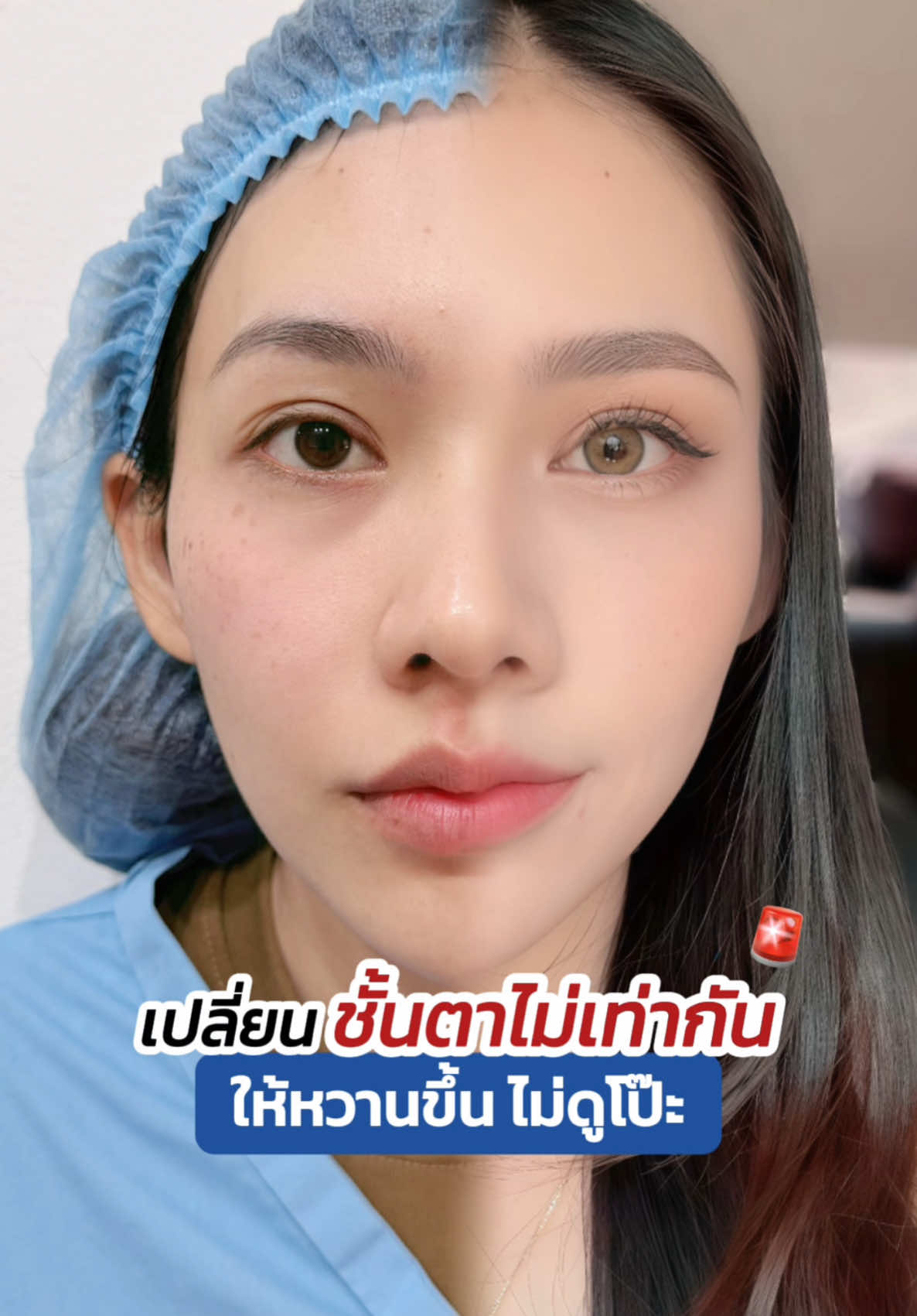 เปลี่ยนชั้นตาไม่เท่ากัน ให้หวานขึ้นไม่ดูโป๊ะ💖 #รีวิวตาสองชั้น #skyclinic #ทำตาที่ไหนดี #sweeteyes #จักษุแพทย์ #ทีมแพทย์หมอสกาย #ศัลยกรรมตา 