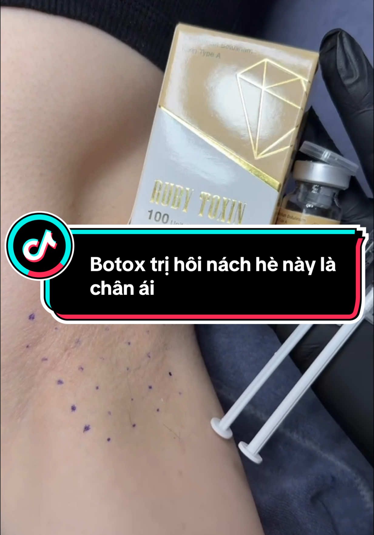 B.o.t.o.x trị hôi nách mùa này là chân ái ❤️