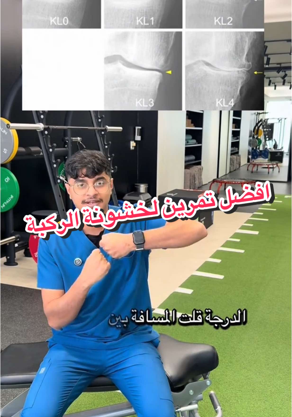 خشونة الركبة أو الفُصال العظمي هي تآكل تدريجي في غضروف مفصل الركبة، مما يؤدي إلى ألم وتيبس مع الحركة. تظهر غالباً مع التقدم في العمر أو نتيجة لإصابات متكررة، زيادة الوزن، أو ضعف العضلات حول الركبة. الأعراض تشمل الألم أثناء المشي، صعود الدرج، أو بعد الجلوس لفترة طويلة، مع احتمال صدور صوت طقطقة. العلاج يشمل التمارين المقوية، فقدان الوزن، العلاج الطبيعي، وفي الحالات المتقدمة يمكن اللجوء للجراحة #الم #علاج_طبيعي #خشونة_الركبة #احتكاك_الركب #تمارين 