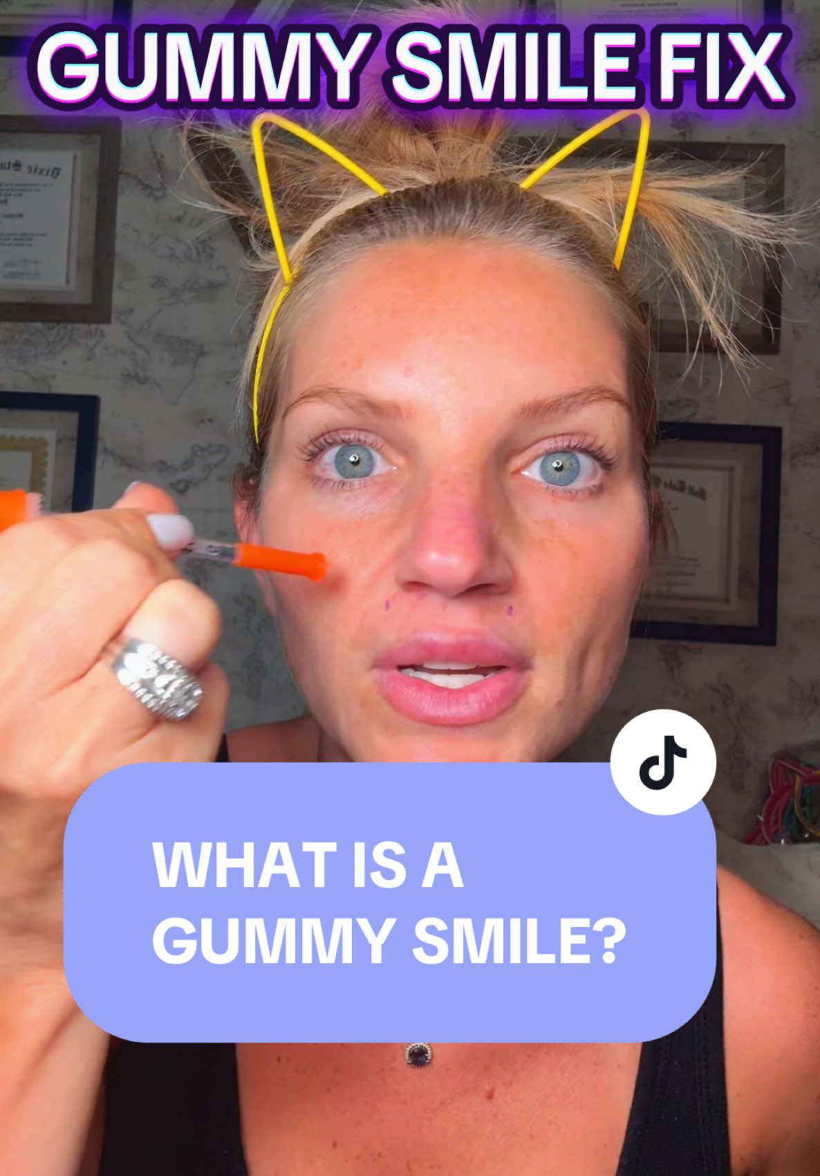 NEUROTOXIN FOR GUMMY SMILE #neurotoxin #xeomin #botox #aesthetics #facialexpressions #injector #fypシ #fyp #howtotiktok #medicaltips #medicaltiktok #badbotox #botoxresults #dysportinjections #injections #nursepractitioner #beauty #beautyhacks #beautytips 