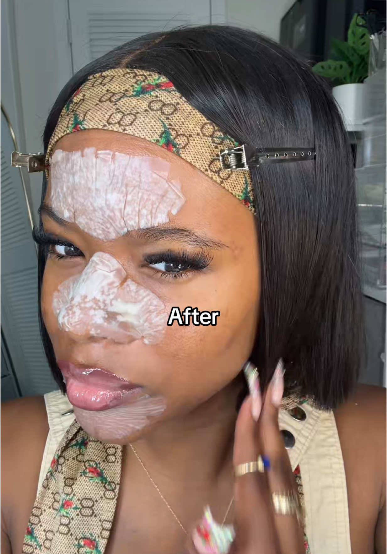 Come back for the reveal 😩 #noseporepatch #peachslices #satisfying #skintok #acnejourney #fy 