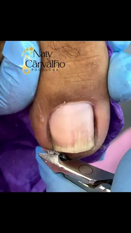 #podologanatyscarvalho #podologas #videossatisfatorios #ingrowntoenail #ingrownsatisfying 