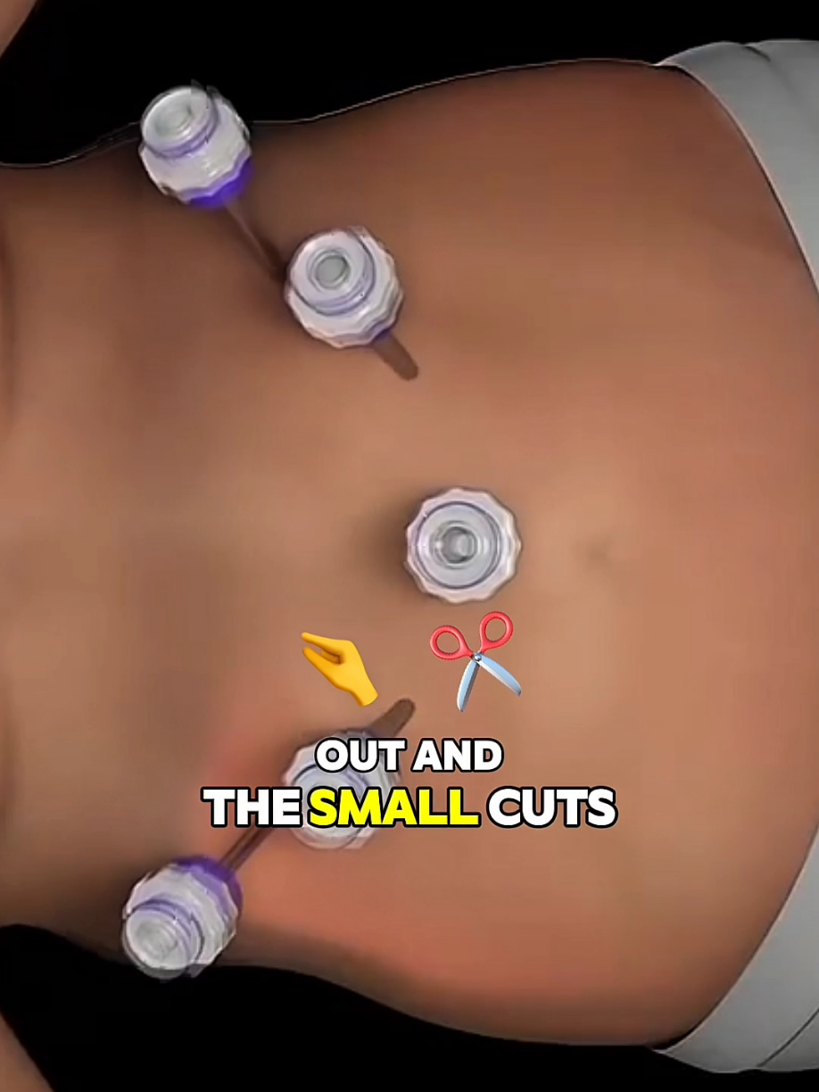 This Is How Weight Loss Surgery Changes Your Body from the Inside! #WeightLossSurgery #BariatricSurgery #HealthTransformation #MedicalExplained #TikTokHealth #DoctorTok #HowItWorks #BodyGoals #ObesityTreatment #HealthAwareness