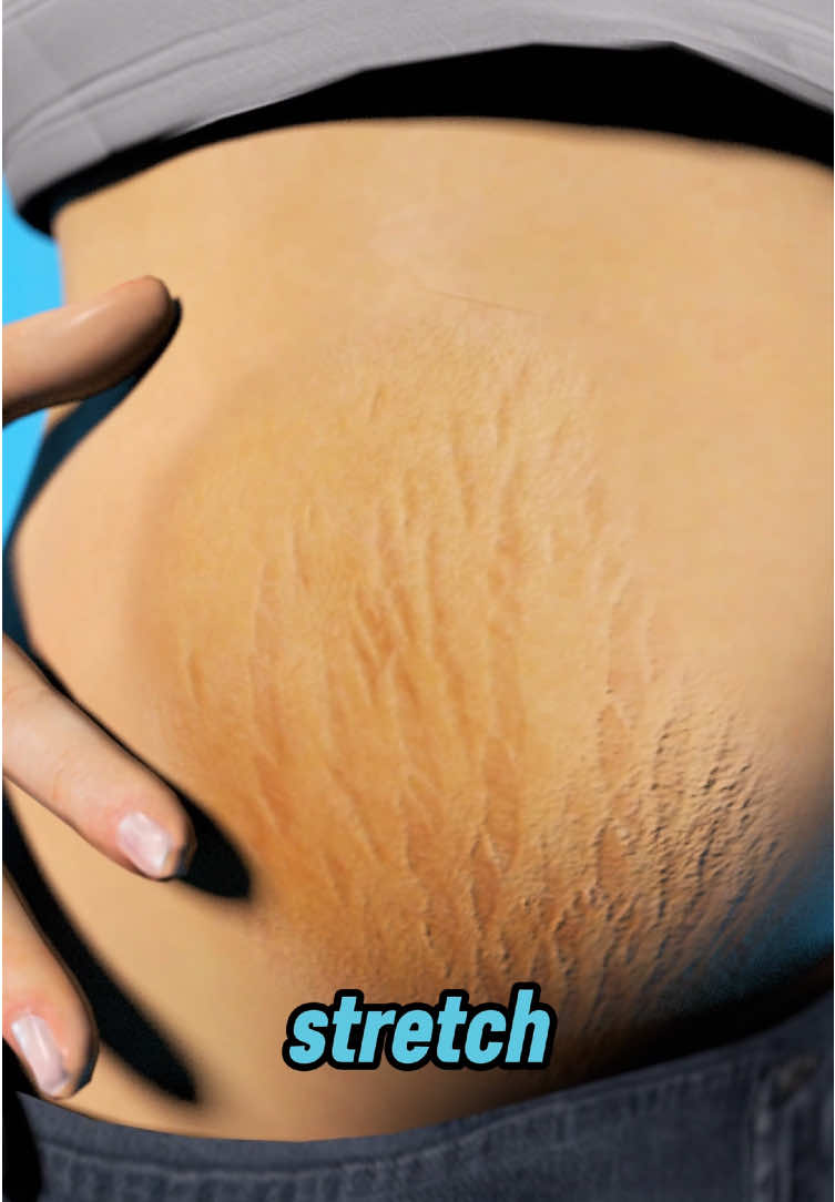 When your body grows too fast, like during pregnancy or sudden weight gain, your skin struggles to keep up. Deep beneath the surface, collagen and elastin tear, forming tiny wounds. As they heal, scars appear as silvery or reddish lines we call stretch marks. These marks aren't flaws, they're proof that your body has adapted, endured, and changed. #stretchmarks #skinscience #bodychanges #collagen #elastin #skincarefacts #dermatology #selflove