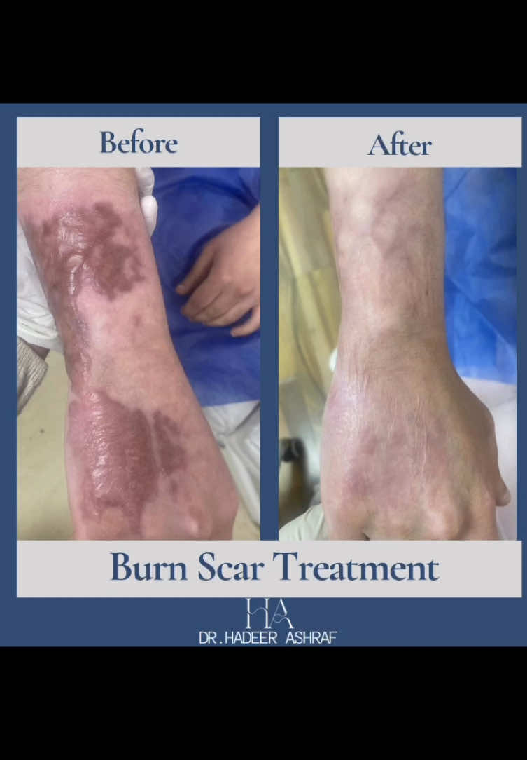 Burn Scar Treatment ✨♥️ Combination therapy can produce life changing results for you . علاج ندبات الحروق من اكتر الحالات تحدي بس كمان هي من اكتر الحالات الي بتبسطني نتيجتها لانها حقيقي بتفرق جدا في حياة المريض ♥️✨ د/ هدير أشرف  اخصائية الجلدية والتجميل والليزر  #dermatology #dermatologist #antiaging #drhadeerashraf #scar #fractional_laser  #burn  #burnscars 