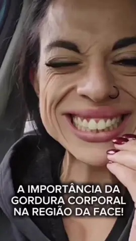 🔴 ALERTA: QUANDO A GORDURA VAI EMBORA, A FLACIDEZ CHEGA COM TUDO! Você sabia que a gordura facial é o nosso “preenchimento natural”? Ela dá volume, sustenta e mantém o contorno do rosto harmônico. Mas com o tempo ou com a perda intensa de gordura corporal essa camada preciosa vai diminuindo, e o resultado é inevitável: flacidez, sulcos profundos e aquele ar de cansaço. 💡 Um exemplo clássico? Atletas em preparação para campeonatos de fisiculturismo. O corpo fica seco, definido… Mas o rosto? Vai “murchando” a cada semana. ➡️ Por quê? Porque perder gordura corporal também significa perder gordura nas regiões da bochecha, têmporas, olheiras… E o que sobra é pele. A solução mais óbvia costuma ser: “Vamos preencher!” Mas cuidado ⚠️ Se feito sem critério, isso pode deixar o rosto com um aspecto pesado, artificial, até deformado. 👉 A flacidez não se corrige com apenas alguns mls de ácido hialurônico. É preciso uma abordagem completa: 🔹 Reabilitar a pele 🔹 Fortalecer a musculatura 🔹 Tratar a estrutura 🔹 Respeitar a anatomia individual ✨ Hoje existem técnicas muito mais inteligentes, sutis e naturais para devolver sustentação ao rosto sem exageros. Quer saber quais são? Me conta aqui nos comentários! 👇 Dra. Cláudia Cenci Guimarães Médica pela Sociedade Brasileira de Dermatologia - CRM-SP 79678 Clínica, Estética e Laser. 📍 Rua Barão de Piratininga, 142 Jardim Faculdade, Sorocaba/SP 📞 (15) 3342-1967 | WhatsApp: (15) 98181-4488 Nota: Procedimentos médicos e estéticos podem melhorar a aparência, mas não garantem perfeição. Resultados variam conforme o organismo e o tipo de pele, podendo exigir múltiplas sessões. Este conteúdo é informativo e não substitui avaliação médica. #HarmonizaçãoFacial #FlacidezFacial #PerdaDeVolume #PreenchimentoNatural #SemExageros #BelezaComNaturalidade #RejuvenescimentoFacial #EstéticaAvançada #Antiaging #DermatologiaEstética #HarmonizaçãoSemExcesso #FisiologiaFacial #SaúdeDaPele #EnvelhecimentoSaudável #VolumeFacial #TratamentoFacial #BelezaConsciente #GorduraFacial #EstéticaComSegurança #RostoNatural