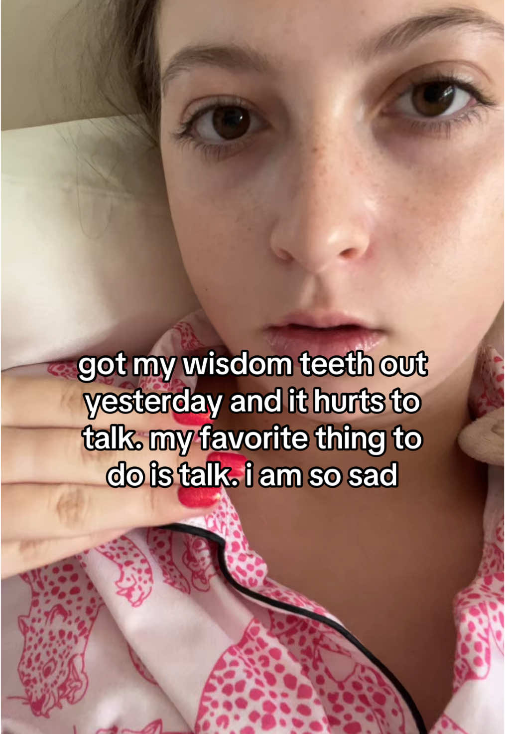 can’t wait for the bruising too😻😻 #wisdomteeth #wisdomteethremoval #ouch