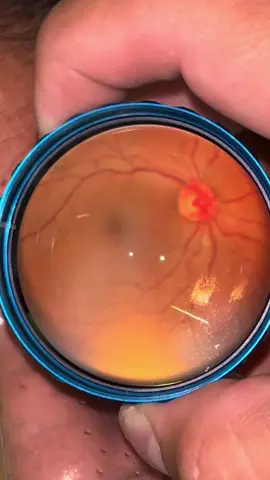 Al hacer un examen de fondo de ojo, se pueden detectar o descartar múltiples patologías de la retina y el nervio óptico, este caso es un examen normal de la retina 😁 #oftalmologia #fvp #ojos #vision #cuidadoocular #saludvisual #prevencion #felicidad #controlderutina #tarija🇮🇩 #bolivia #retina #fondodeojo 