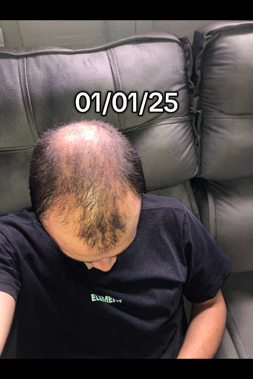Aí está um pouco do que passo no cabelo para evolução capilar 🧑‍🦲#minoxidil #calvo #cabelo #evolution #autoestima #tratamientosparaelcabello 