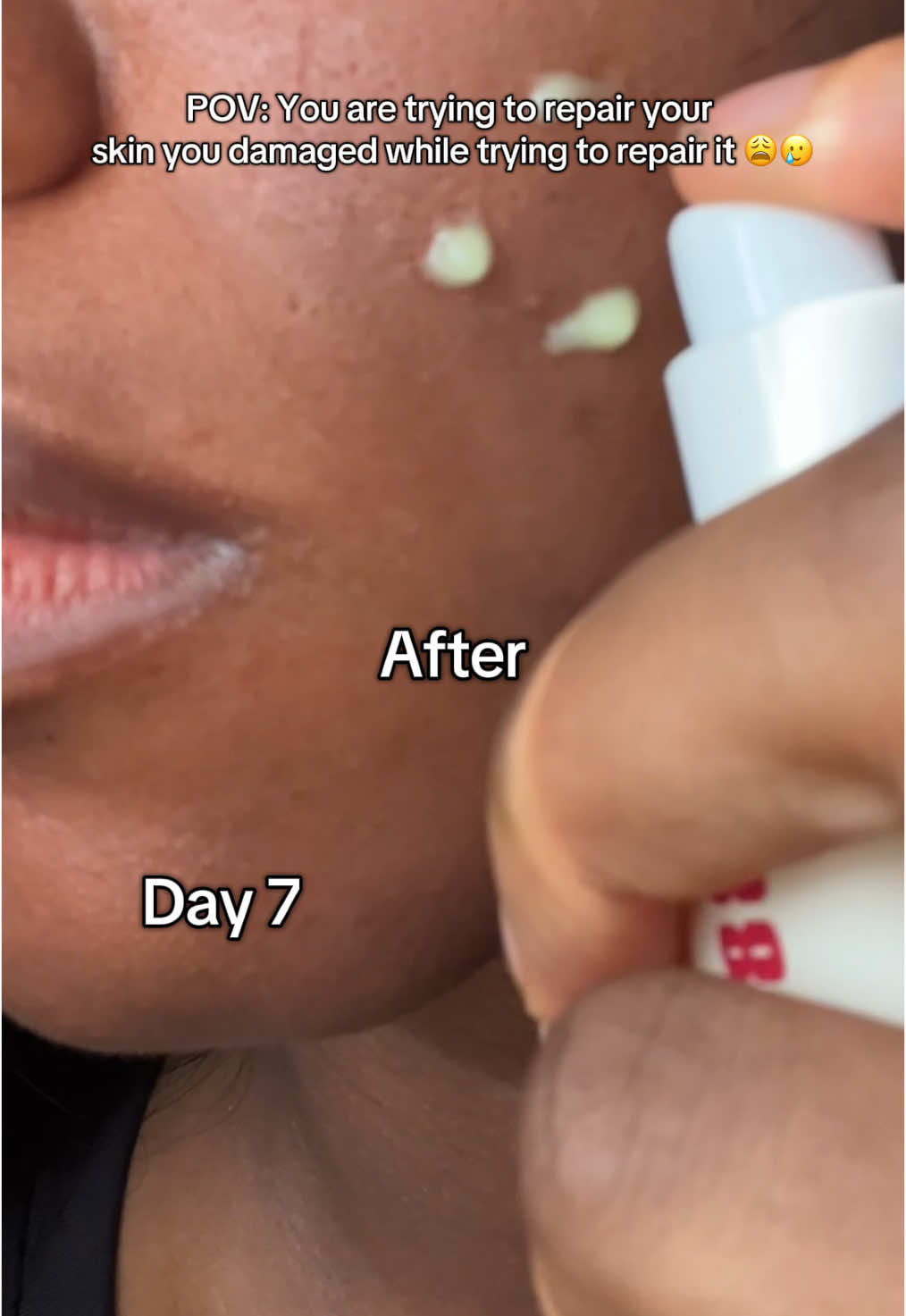 I tried bleaching my sunburn scars and ended up with even more hyperpigmentation 😩. My skin became irritated, patchy, and even more uneven than before. I decided to stop the harsh products and switched to KSecret’s retinal serum — and in just 7 days, I noticed a huge difference! My skin looks calmer, brighter, and more even without any irritation. Sometimes gentle and consistent really is the key. If you’re struggling with stubborn dark spots, skip the bleach and try healing your skin first 💛@KSECRET GLOBAL  #glowupwithretinalchallenge, #seoul1988 #ksecret #retinal #skincare #retinal #7dayschallenge #7daystreatment #7daysresult #scartreatment #brighteningserum #serum #retinalserum #1week #seoul1988 #skincareroutines #ksecret #explore #trendingsounds #trendingaudios #trendingsongs #KsecretRetinal #LipLighteningJourney #PigmentationAroundMouth #BarrierRepairSkincare #DarkLips #BeforeAndAfterSkincare #SkincareReview #BlackSkinCare #ksecret #retinalserum #hyperpigmentation #sunburnscars #acnescars #retinal #skincarejourney #7dayschallenge #skincaretransformation #gentleskincare #melaninskin #darkspotremoval
