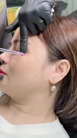 Tiêm xoá nhăn đuôi mắt cho c khách Hà Nội 😍😍😍😍 #tiêmFiller #TiêmBotox #tiêmHACollagen #tiemtriseoloi #tiêmquầnghốcmắt #Tiemfiller #fillerbotox_HP #BAPJALUPRO6 #tiêmthongọnhàmhảiphòng 