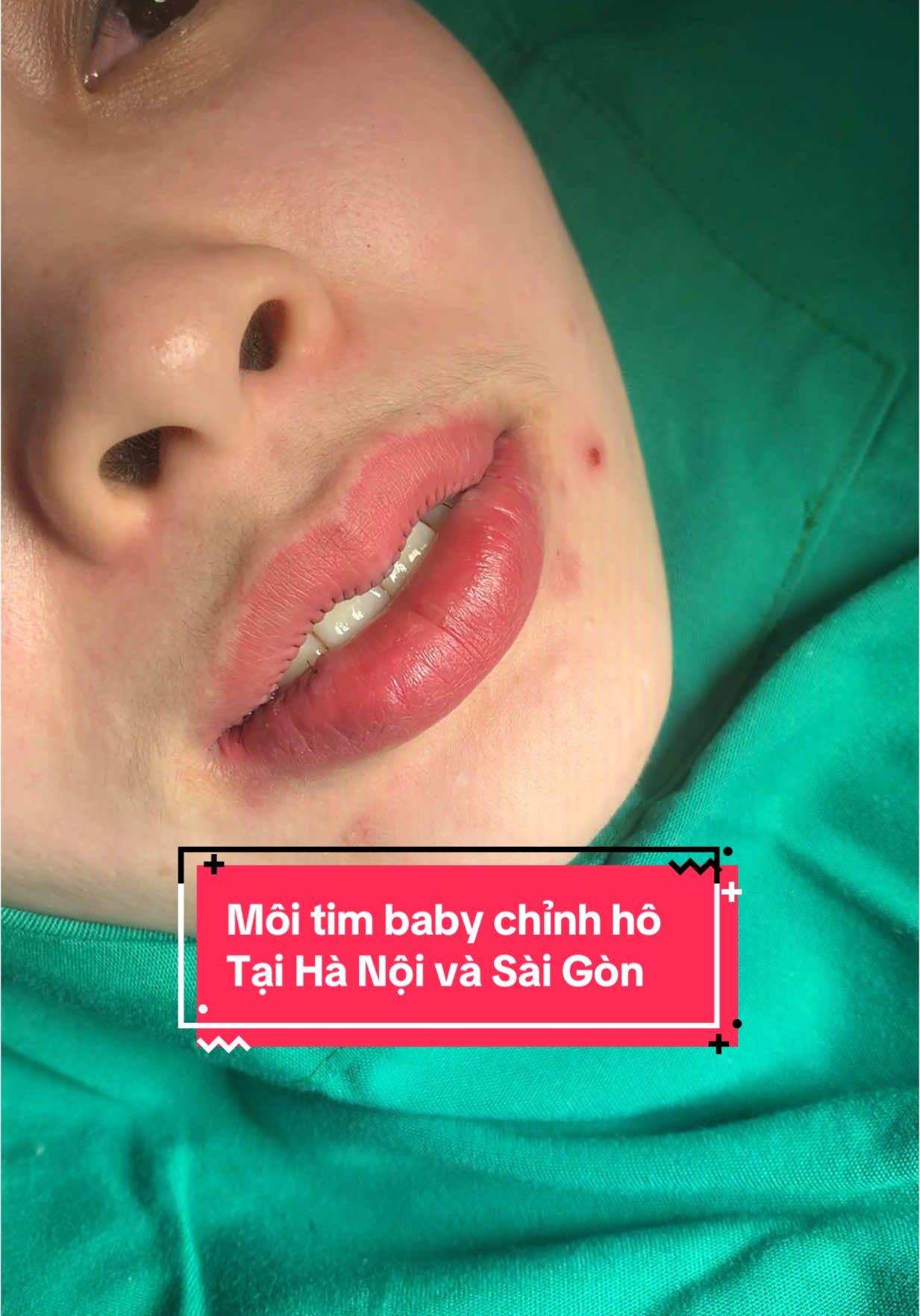 Môi tim baby chỉnh hô  Tại Hà Nội và Sài Gòn#cắtmôitimtựnhiên #thẩmmycamellia #cătmoitim #nhấnmiplasma #cắtmoitraitim #gaixinhtiktok #gaidep 