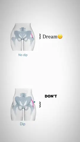 I hate it💔 #hipdipstruggles #hipdip#hips#body #fypシ゚ #foryoupage #fyppppppppppppppppppppppp #fypシ゚ #fypシ゚viral🖤tiktok #fypシ゚ 