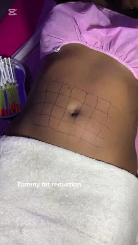 Get rid of stubborn fats in your body. Fo appointment 08060007670. Location: 99 Faulks rd Beside Ikonne Motors Aba. #bodybuilding #fyp #fatdissolvinginjections #fatdissolving #fatdissolvinginjectionsinaba #abaspa #abaspaplug #fypシ゚ #spainaba #medspa #medspainaba #tummyfatreductionaba #foryoupage #reels #explore #exploremore #fatloss #fatlosstips #fatlossinaba #lemonbottle #trendingvideo #beauty #beautyinjectionsinaba #ndybeautyspa #tummyfattreatmentinaba #spaspecialistinaba #spamassageaba #womeninabia #womeninaba #celebrity 