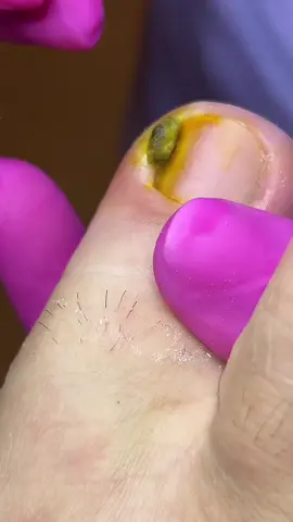 Como a área estava muito sensível, optamos por aplicar o ácido inicialmente para reduzir a inflamação. No dia seguinte, a paciente retornou e realizamos a remoção do granuloma. Seguimos até total cicatrização 