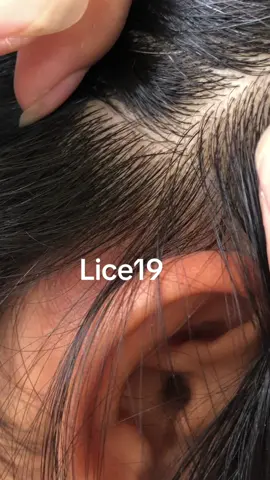 😱😱#omg #lice #liceremoval #fo 