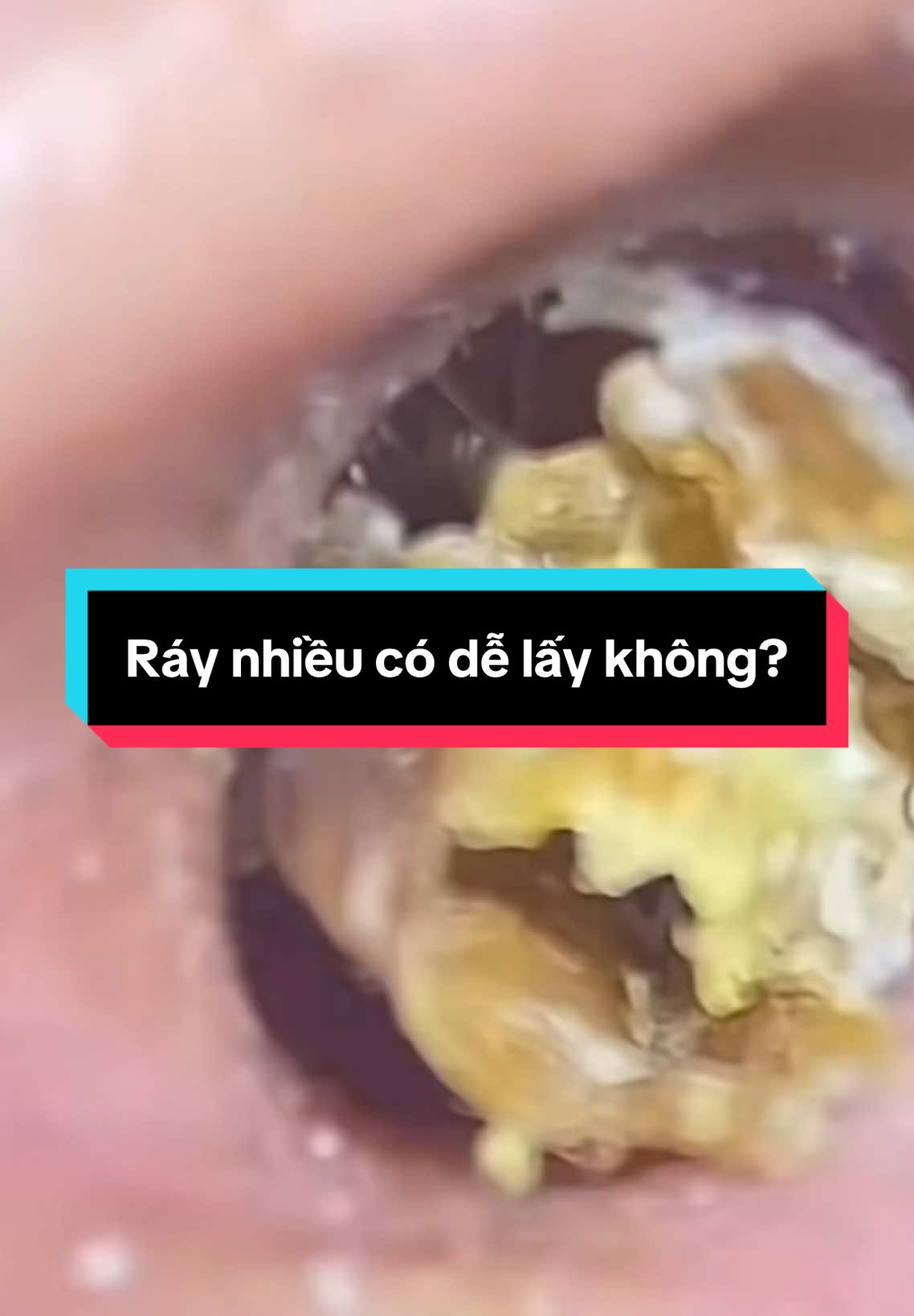 Nhiều khách tai ít ráy thì lại ước tai mình có nhiều ráy như này.#raytai #xuhuong 