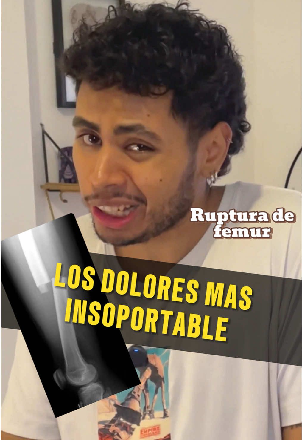 La ruptura de femur es la peor, pero las otras no se quedan atras.#femur #ruptura #dolores #frotkin #creatorsearchinsights 