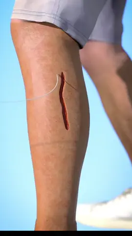 How Stitches Work 🤯