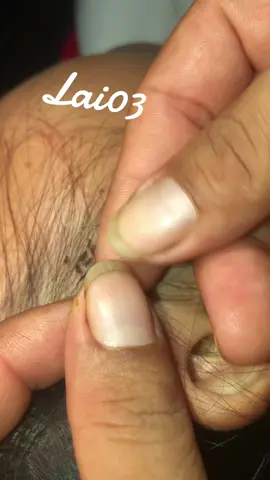 Remove lice #omg🙀😱😰😱❤️❤️ #lice #liceremoval 