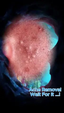 #squeezeyuk #satisfying #pimple #foryou #relax #funny #fpy 