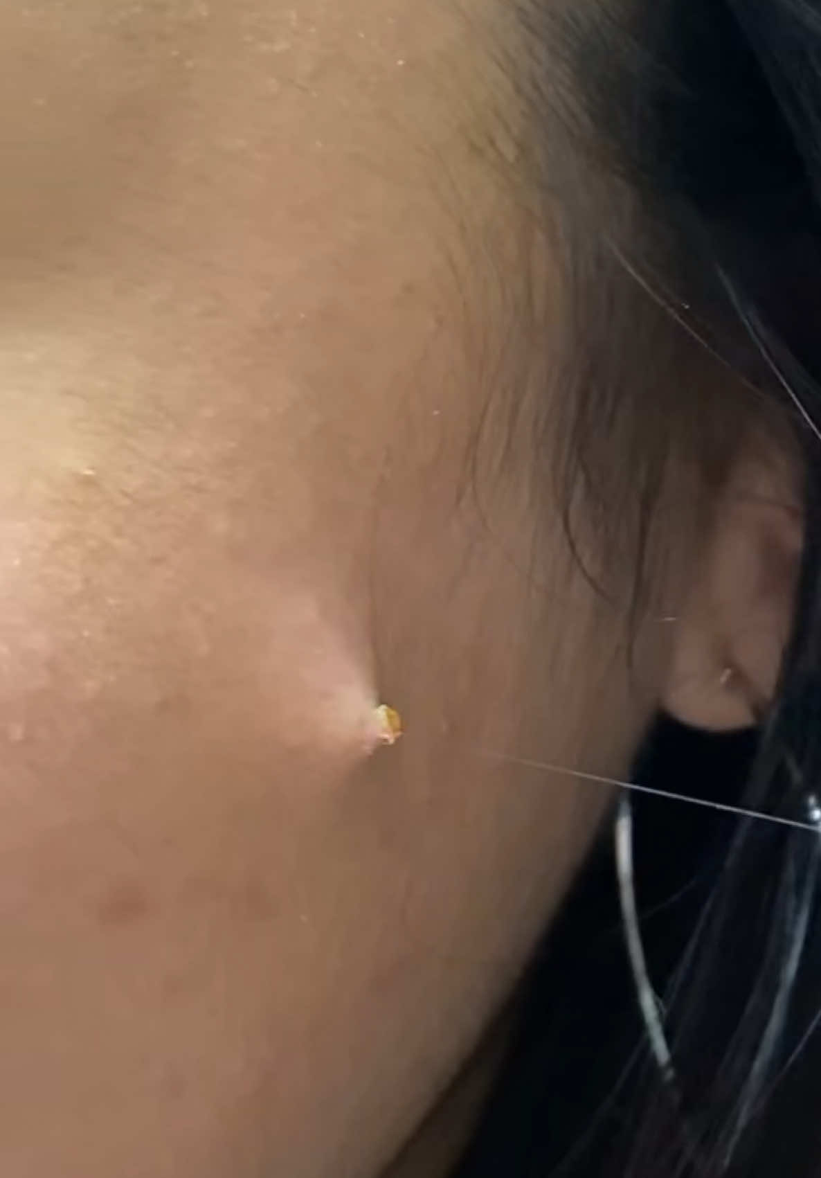 #fyp #pimple #pimplepopper #pimples #drpimplepopper #fypシ #fypage #fyppppppppppppppppppppppp #mexican #mexicantiktok #funnyvideos 