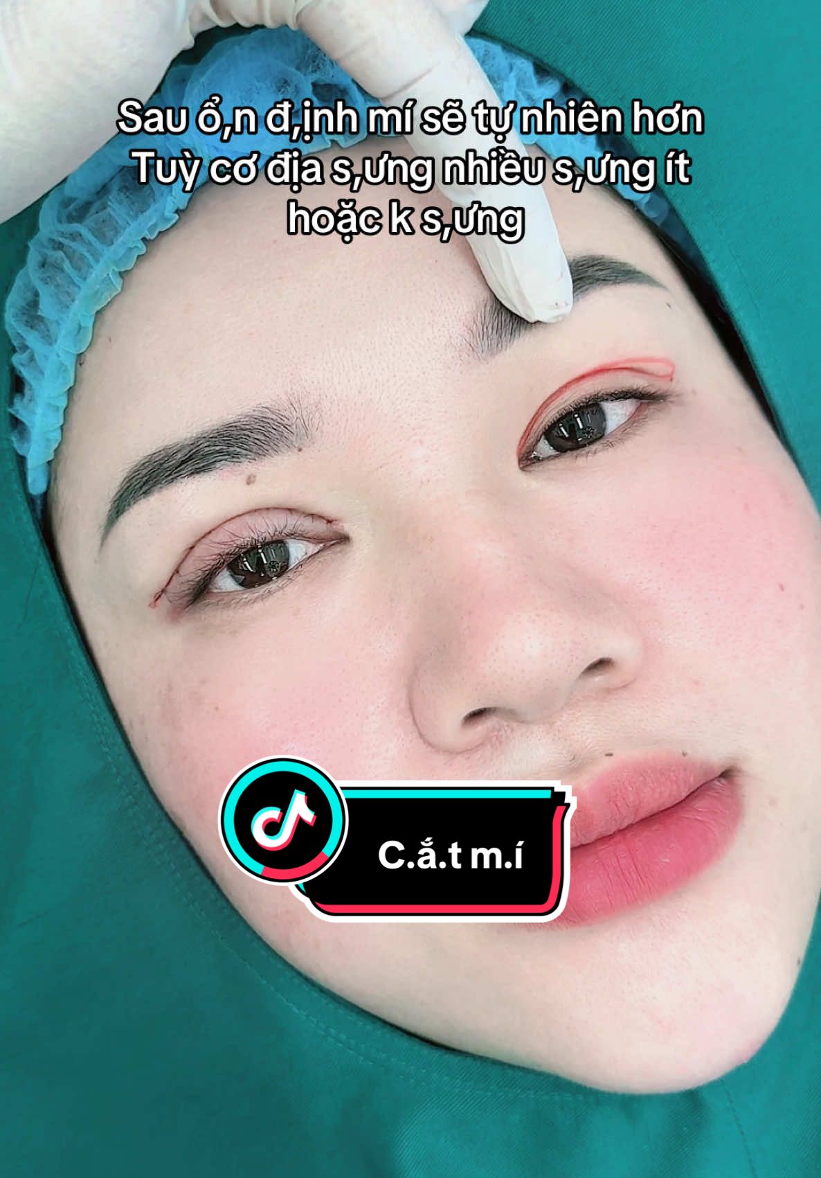 Sau ổ,n đ,ịnh mí sẽ tự nhiên hơn  Tuỳ cơ địa s,ưng nhiều s,ưng ít hoặc k s,ưng #cắtmíđẹp #nhấnmí #treocungchanmay #trend #mí #tik_tok #xuhuong #thẩmmỹ #tiểuphẫu 