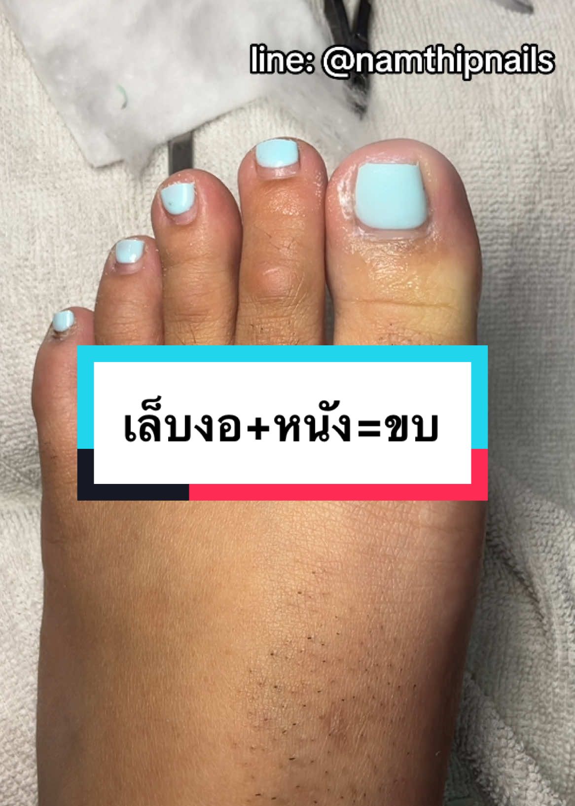 💓 #namthipnails #ตัดเล็บขบ #ตัดหนัง #ทำเล็บ #ร้านตัดเล็บขบ #ร้านตัดเล็บขบราม2 #ตัดเล็บ #เล็บขบ  #เล็บเชื้อรา Fb : namthipnails  Line : @namthipnails  นัมเบอร์วัน8 ตลาดม.ราม2  กทม  Map: namthipnails  https://goo.gl/maps/JmwpCKLfKwmhKGK96  ร้านเปิดทุกวัน เวลา12.00น-22.00น.