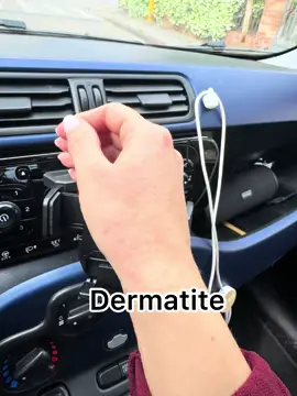 Combattendo una vita contro la dermatite. #dermatite #cura #cortisone #elocon #pomata #skin #pelle #hands #mano #guarigione 