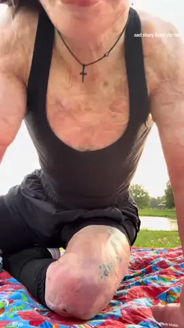 this is so sad #Storytime #burnvictimawareness #Fy #fypage #Fyp 