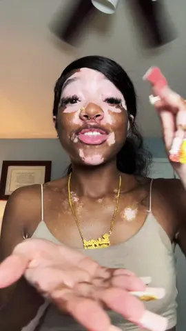Yes it was that DAMN LEO 😂🙄 | #fyp #vitiligo 