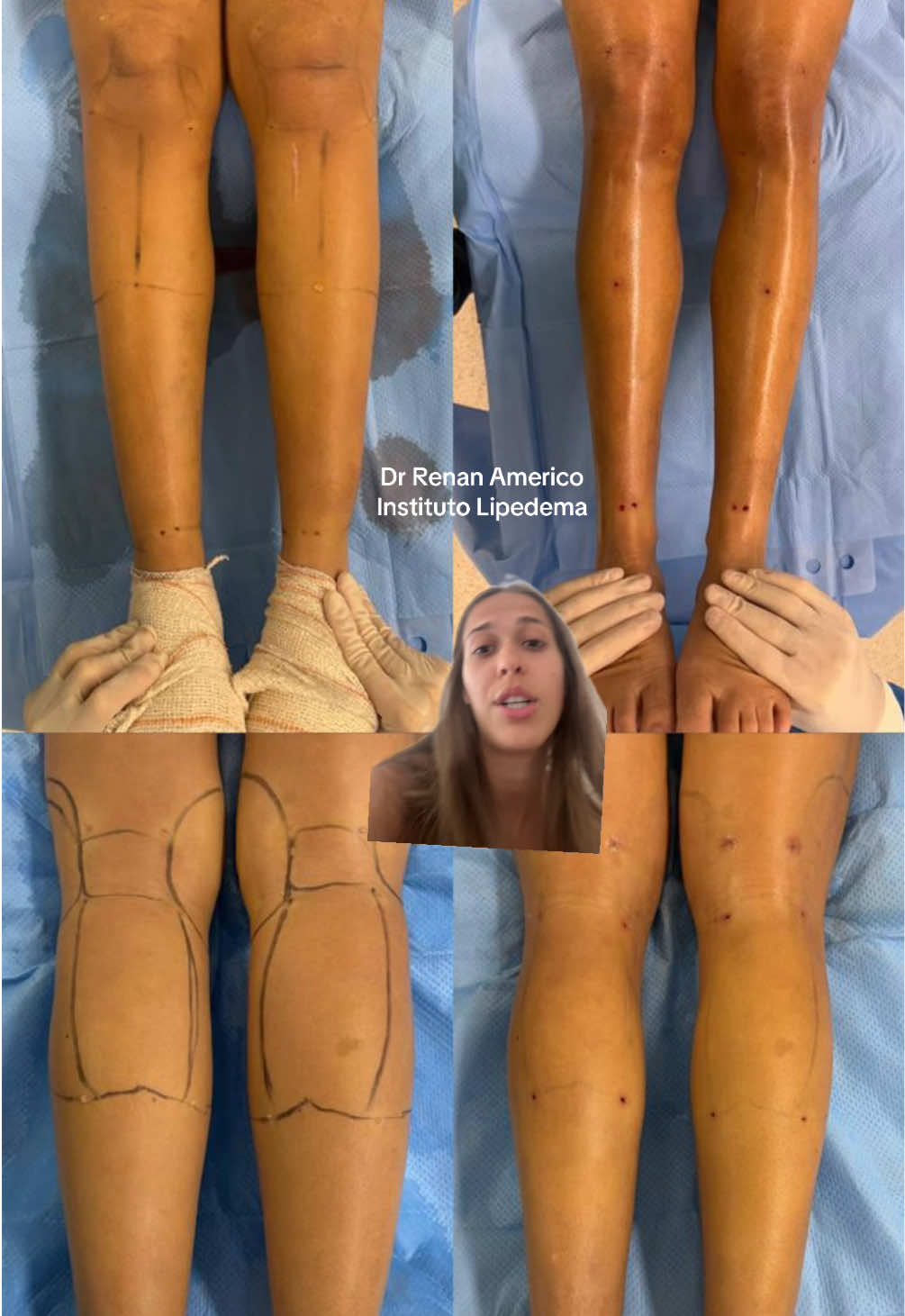 Operei meu lipedema tipo 5 (do joelho pra baixo) grau 1 - com o Dr Renan Americo do instituto lipedema ✨ 