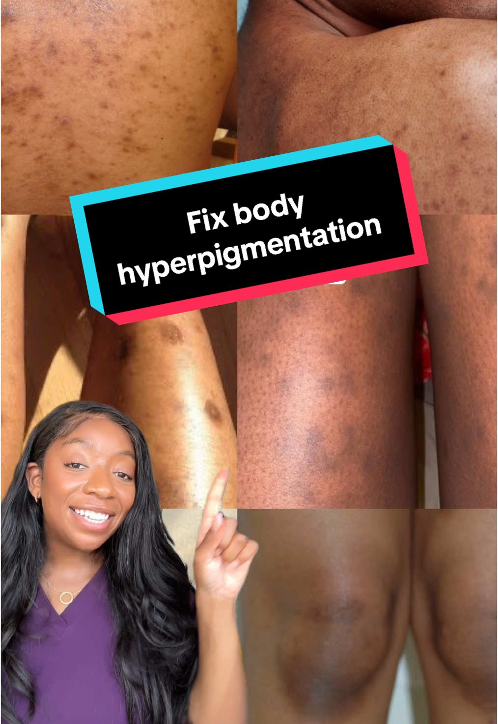 Dark knees? Elbows? Uneven skin tone? I got you. Here’s how I treat body hyperpigmentation from head to toe: 1️⃣ Glycolic acid toner on dark areas like knees & elbows 2️⃣ Glycolic acid body wash 2-3x a week 3️⃣ Retinol body lotion (this is a game changer) 4️⃣ Lock it in with a rich body butter + body oil combo This routine changed my skin. Comment your fave products below so we can all glow together. #blackgirltiktok #bodycaretips #bodyhyperpigmentation #melaninskincare  #glycolicacid #retinolbodylotion 