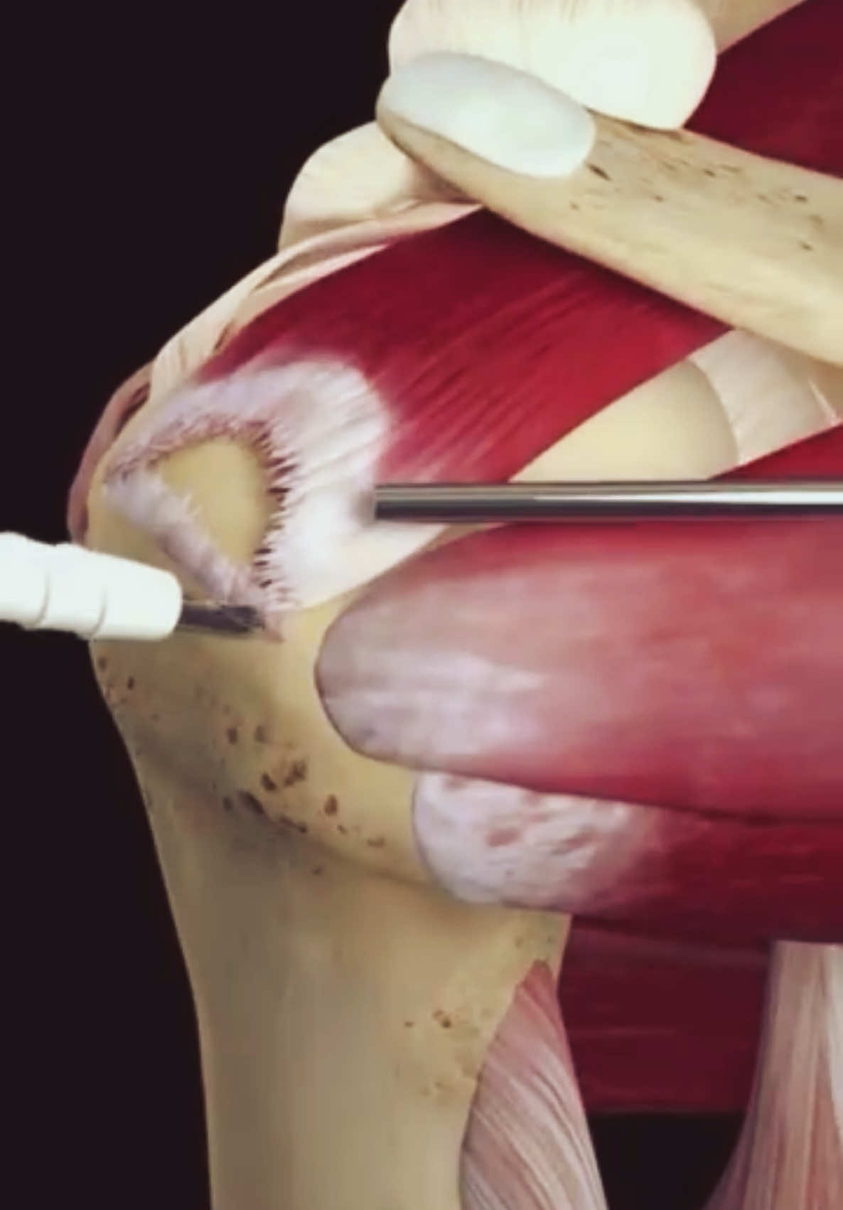 #manguitorotador #rotatorcuff #rotatorcuffexercises #fisioterapia #rotatorcuffinjury 