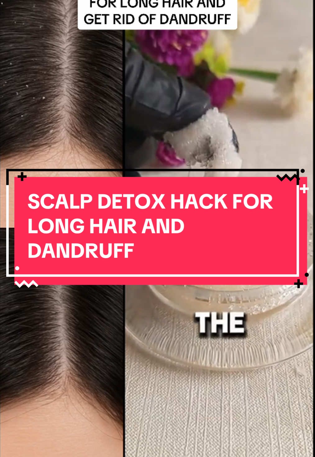 A scalp detox recipe to get rid of dandruff and have long hair. #antidandruff #longhair #naturalremedies 
