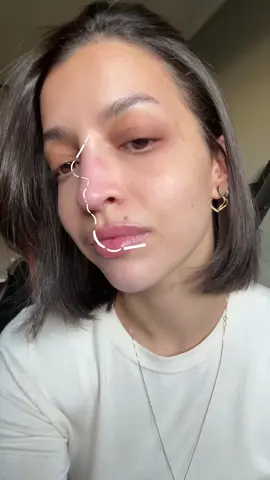 #perfil #perfiloplastia #hof #preenchimento #estetica #trend #meme #beleza