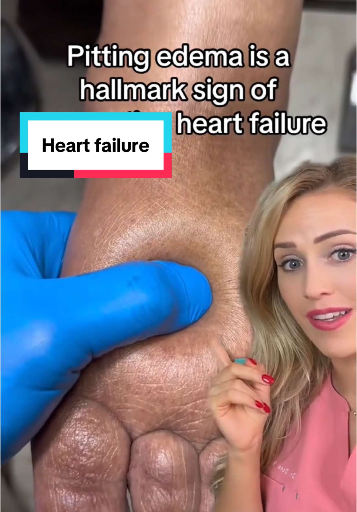 Pitting edema is often heart/kidney failure, but there are many other causes. It’s important to talk to a doctor if you have this! VC: @dcfootdoctor  #feet #pittingedema #foothealth #doctor #doctorreacts
