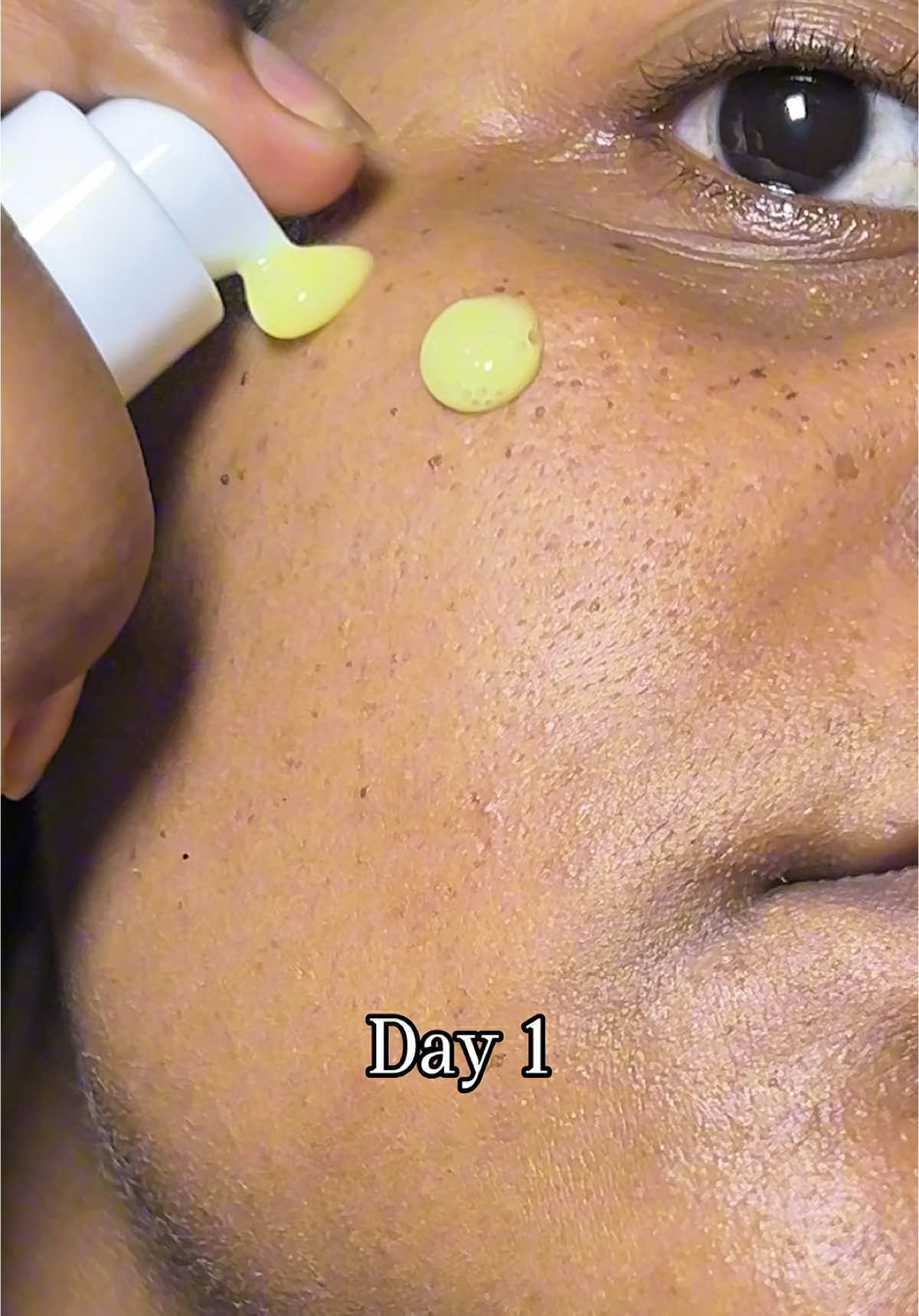 My before and after using the Serum, changed my skin in 7 days  @KSECRET GLOBAL  . . . #glowupwithretinalchallenge #ksecret #seoul1988 #SkinCare #skintok #kbeauty #koreanskincare #skincareroutine #7days #retinalserum #acneserum #poreserum #rednessserum #glassskin #glowyskin #fyp #glowyskincare #skincare #skintok #kbeauty #koreanskincare #skincareroutine #10days #7days #retinalserum #acneserum #poreserum #rednessserum