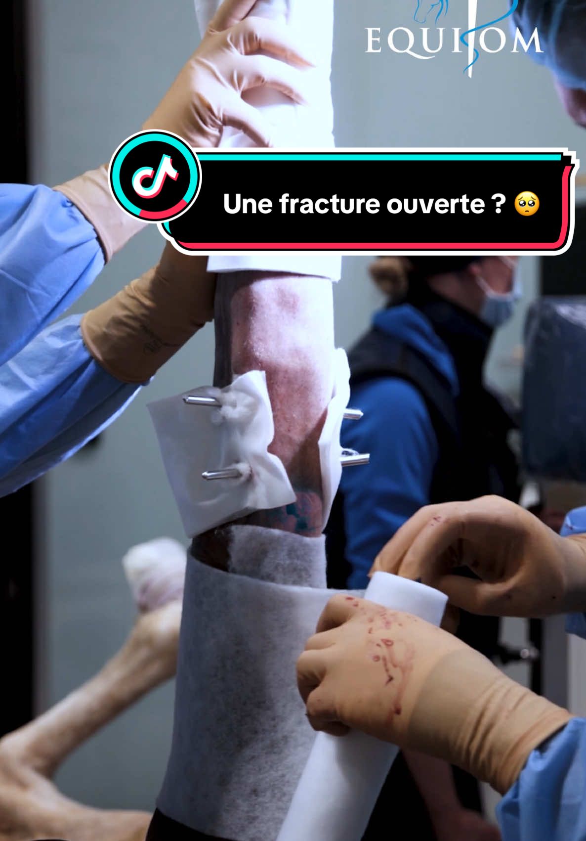 🦴Fracture du canon - on vous donne des nouvelles !  Dans notre dernier post, on vous partageait le cas critique d’une fracture ouverte du canon sur un jeune cheval, avec un pronostic vital engagé. Aujourd’hui, on vous emmène au cœur de l’intervention chirurgicale réalisée pour tenter de le sauver. 😷 🔹 Trois vis en compression ont d’abord été posées à travers de petites incisions, pour stabiliser la partie haute de la fracture. Ensuite, deux plaques dorsales et une plaque médiale ont été fixées à l’extérieur de la peau, comme des fixateurs externes, afin de stabiliser le membre dans les deux plans tout en protégeant le site de fracture. 💉Un défaut osseux important a été comblé par un agent ostéo-inducteur injecté, destiné à être progressivement remplacé par de l’os. Des antibiotiques ont également été injectés localement pour prévenir les risques d’infection. 🩹 Enfin, un plâtre transfixé a été mis en place, soutenu par deux broches dans le radius distal. Il permet au cheval de s’appuyer sans solliciter la zone fracturée, grâce à un transfert de charge mécanique. 🤞 Une chirurgie lourde, mais réalisée avec précision et espoir. On croise les doigts pour la suite… et on vous tient au courant !💙