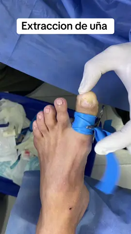 #podologia #enfermeria #sangre #pies #salud #uñas 