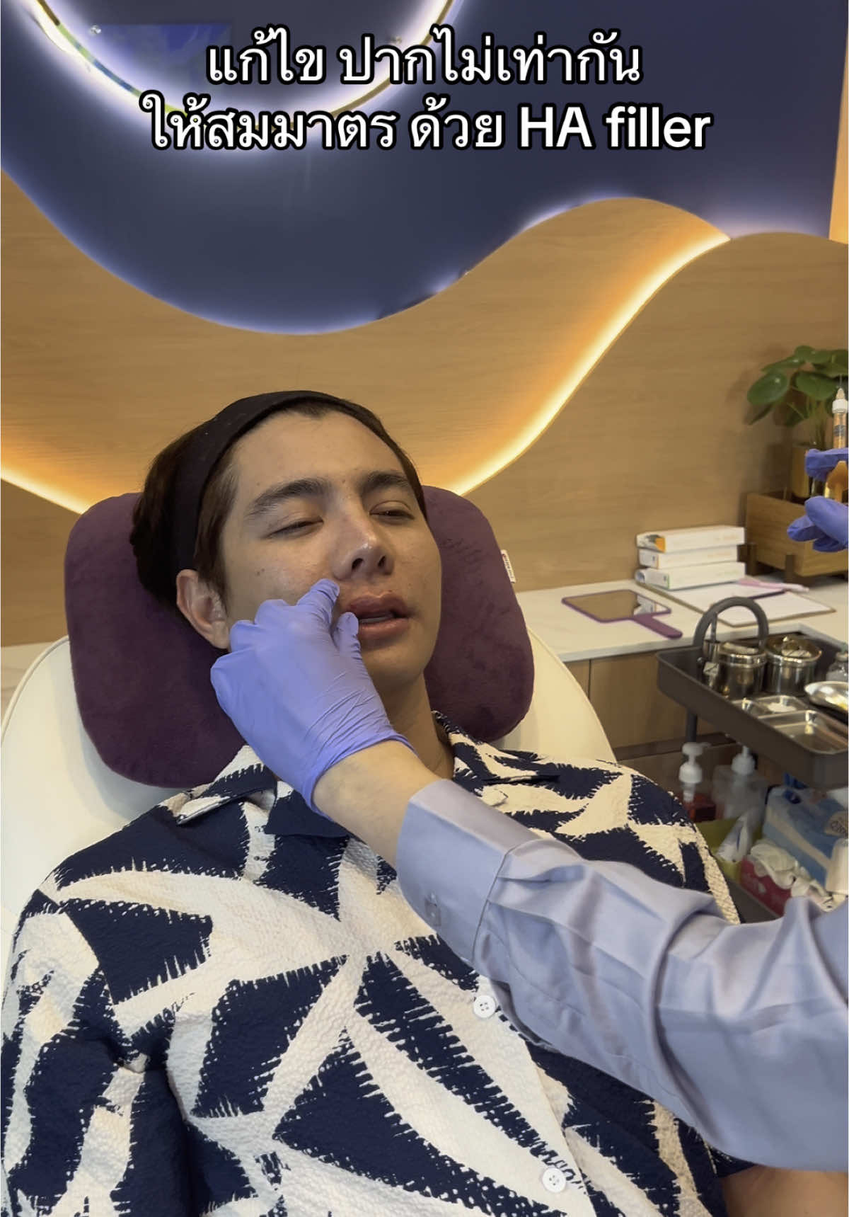 #ฟิลเลอร์ปาก #ฉีดฟิลเลอร์หมอจุน #lipsfiller #meetdrjun #eptq #eptqfiller 