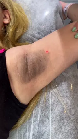 Carbon facials, also known as Carbon Laser Peels or Hollywood Carbon Peels, are a type of facial treatment that involves applying a layer of carbon paste to the skin, which is then treated with a laser. The process is popular for its ability to improve the appearance of the skin. Some of the key benefits of carbon facials include: Deep Skin Cleansing: The carbon paste acts as a deep cleanser, attracting impurities, dirt, and oil from the pores. When the laser is applied, it helps remove these impurities, leaving the skin clearer and fresher. Improved Skin Texture and Tone: The laser energy stimulates collagen production, which helps to improve the overall texture and elasticity of the skin. This can lead to smoother, firmer skinand a more even skin tone. Pore Minimization: By targeting and cleaning out clogged pores, the treatment helps reduce the size of pores, making the skin appear more refined. Acne Treatment: The carbon facial is especially effective for individuals with acne-prone skin. The laser helps to kill acne-causing bacteria and reduce inflammation, leading to fewer breakouts. Brightening and Radiance: The carbon facial can leave the skin looking brighter and more radiant, as it removes dead skin cells and promotes the regeneration of new, healthy skin. Anti-Aging Effects: With increased collagen production, carbon facials can help reduce the appearance of fine lines and wrinkles, making the skin look more youthful.Book your appointment NOW👇 Book your appointment NOW👇 📞 Call/WhatsApp: +92 3244460818 #aestheticcareclinicoficial #Aestheticcare #aesthetic #viral #viralreels #viralvideo #viral #video #HolidayGlow #NewYearNewSkin #SummerSkin #WinterSkinCare #FreshFaced #CoolSculpting #BotoxResults #Microneedling #PRPTherapy #ChemicalPeel #FacialTreatment #LaserHairRemoval #HydraFacial #BodyContouring #VampireFacial #FYP  #TikTokBeauty #InstaBeauty #GlowUpChallenge #TransformationTuesday #BeautyTips #TikTokSkincare #BeforeAndAfter #SkinCareAddict #AestheticProcedures #BeautyTreatments #LaserTreatment #AestheticClinic #SkincareRoutine #BeautyClinic #CosmeticTreatments #GlowUp #SkinGoals #FacialRejuvenation #BotoxBeforeAndAfter #AntiAging #DermalFillers #LipFiller #SkinCareTips #AestheticMedicine