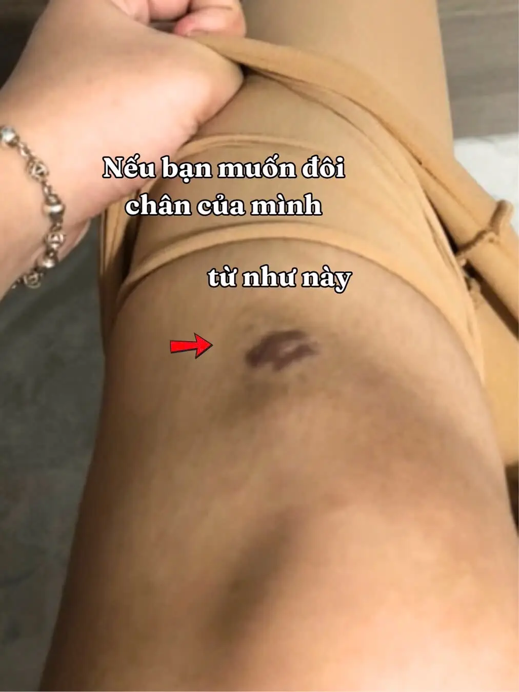 Chọn quần tất che khuyết điểm phải vừa che được sẹo thâm mà vẫn phải tự nhiên nhen #review #chekhuyetdiem #thoitrang #quantat #reviewquanao  #xuhuong #tip #fyp 