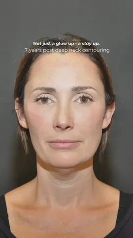 Jawline goals = achieved ✔️ Deep neck contouring by Dr. Marcelo Antunes  📍Austin, TX. #faceaustin #jawline #jawlinetransformation #neckgoals #facialplasticsurgery #drantunes 