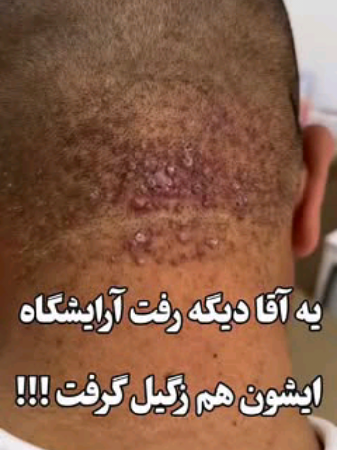 برای درمان کامل زیگیل تناسلی به این شماره در واتساپ پیام بدید👇👇 +9809225831201 #تیک_تاک_فارسی #تیک_تاک_ایرانی #تیک_تاک_افغانی #تیک_تاک_آلمانی #تیک_تاک_انگلیسی #تیک_تاک_زیگیل 
