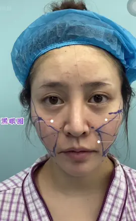 Năng cơ táo , muốn làm đúng bệnh viện bác sĩ này thì liên hệ Na . Nói không với quảng cáo ảo , ăn cắp clip rồi quảng cáo sai . #lamdep #thammydichtrunghoa #thẩmmỹ #xuhuong 